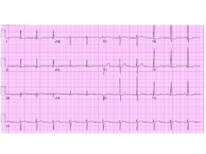 EKG 1