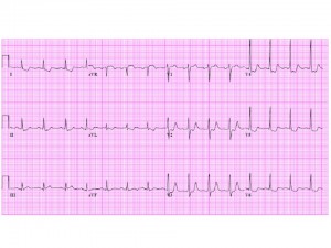 EKG 2