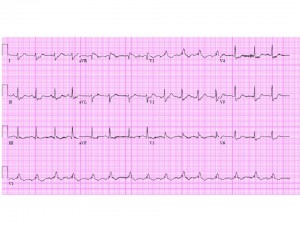 EKG 3