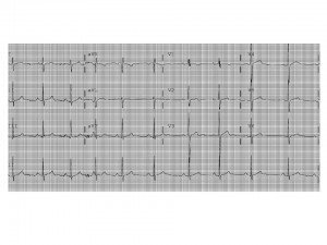 Ahmad_football_EKG image2