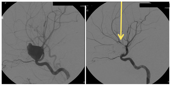 Image shows giant aneurysm before and after coiling. Arrows point to aneurysm filled with coils.