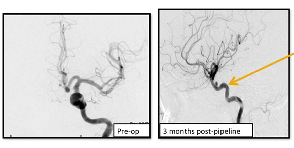 Image shows the remodeling of parent ICA vessel after pipeline placement. Arrow points to where the aneurysm used to be.