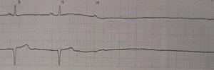 asystole