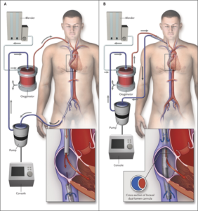 ECMO diagram