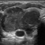 Anaplastic thyroid cancer radiograph